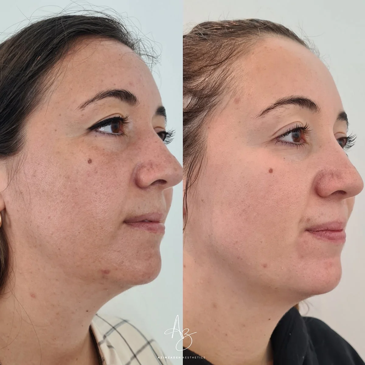 Skin Before And After (3)