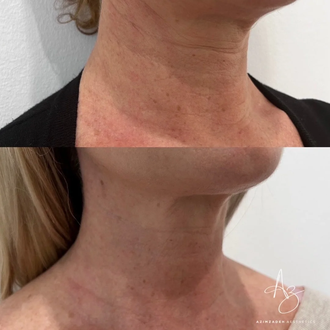 Skin Boosters (2)