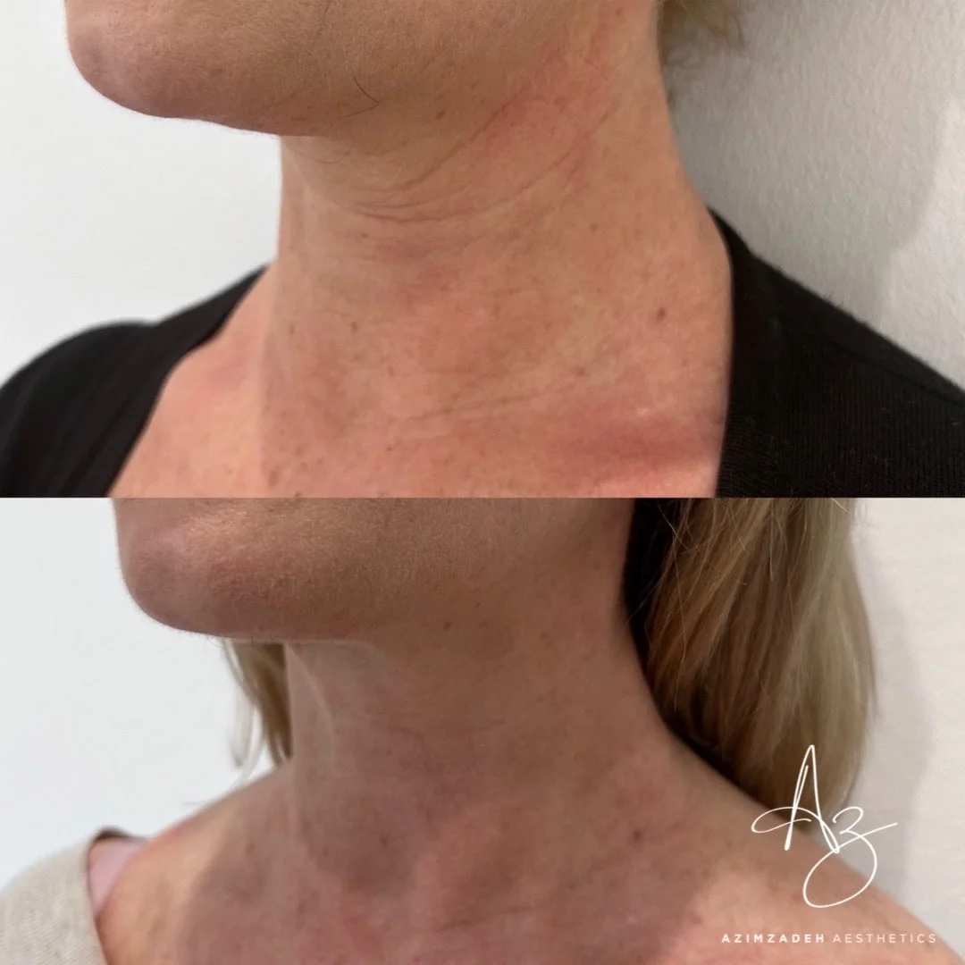 Skin Boosters (4)