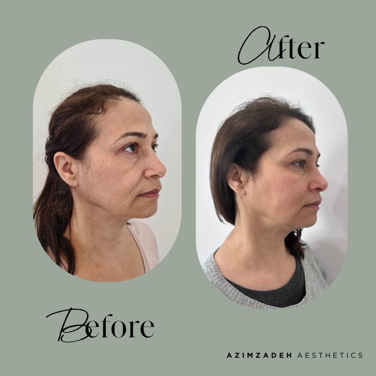 skin dermal filler patient before after azimzadeh aesthetics