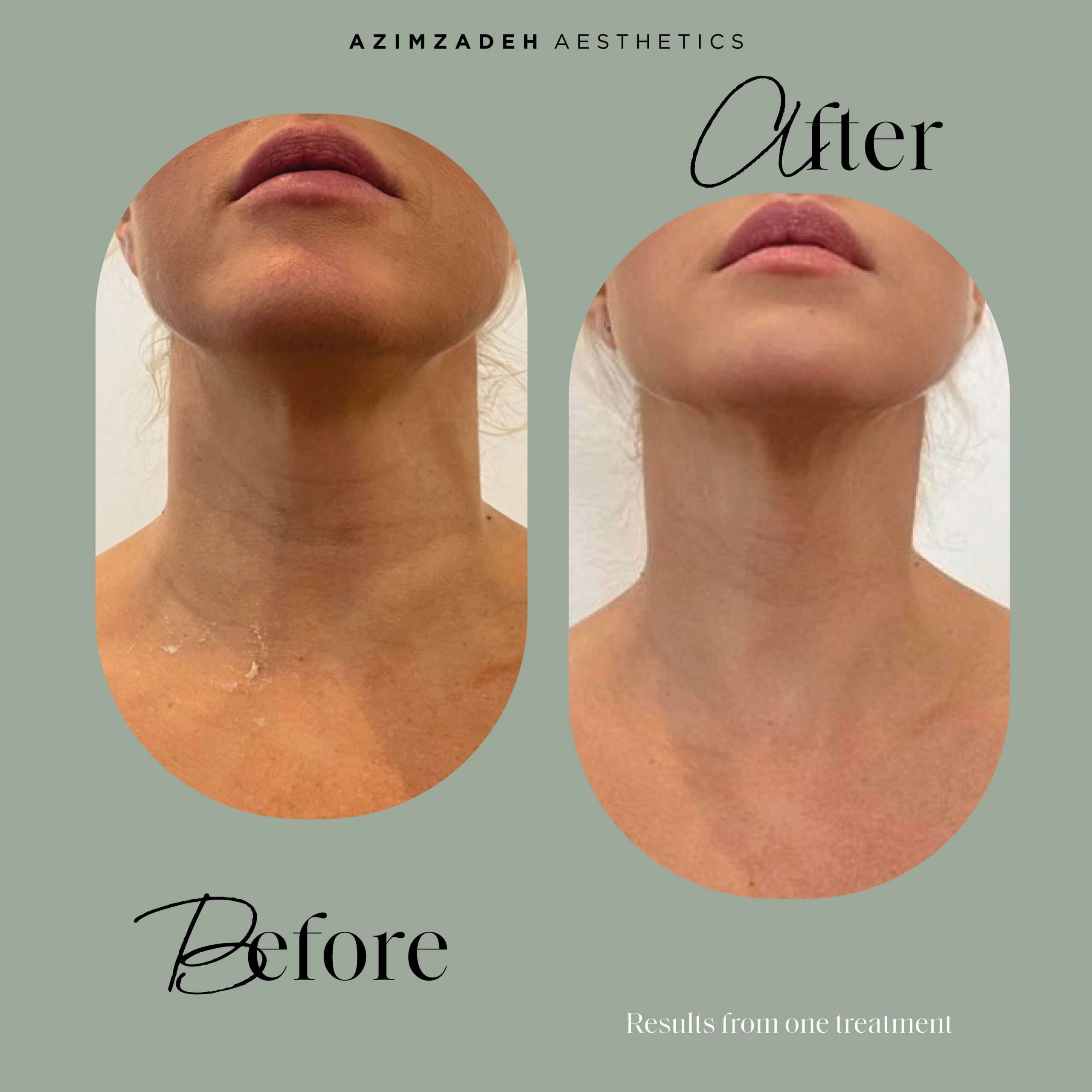 skin dermal filler patient before after azimzadeh aesthetics
