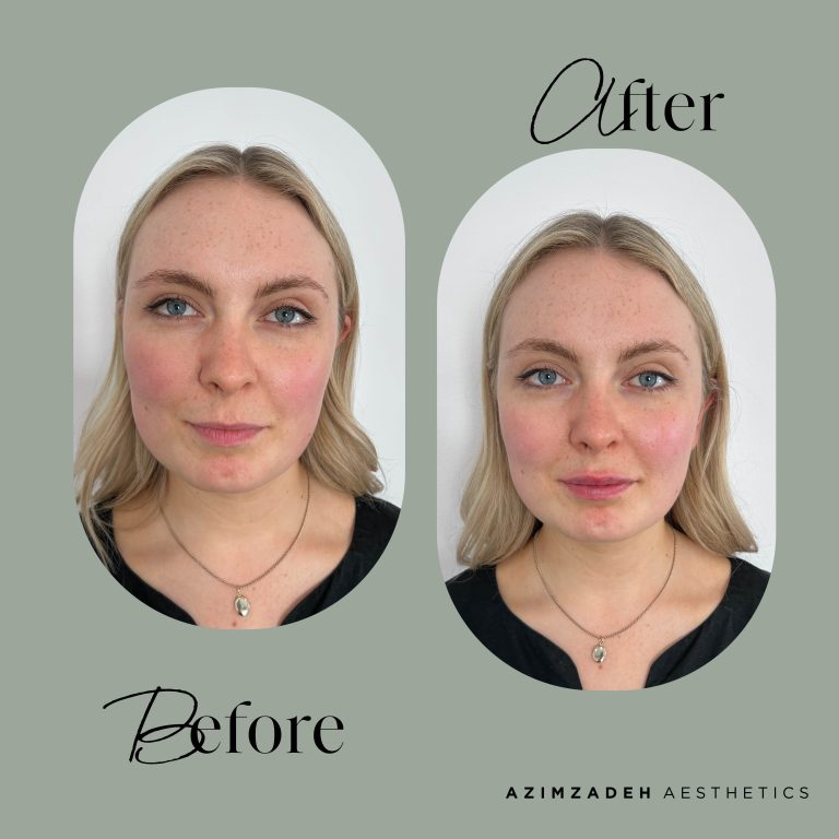 dermal filler patient before after azimzadeh aesthetics