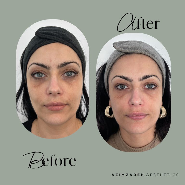 skin dermal filler patient before after azimzadeh aesthetics