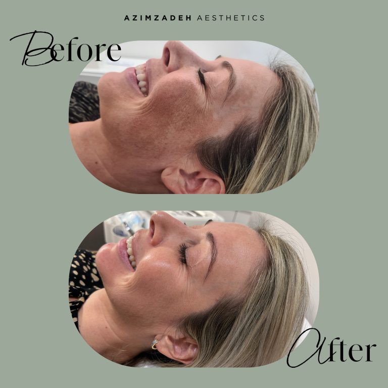 skin dermal filler patient before after azimzadeh aesthetics