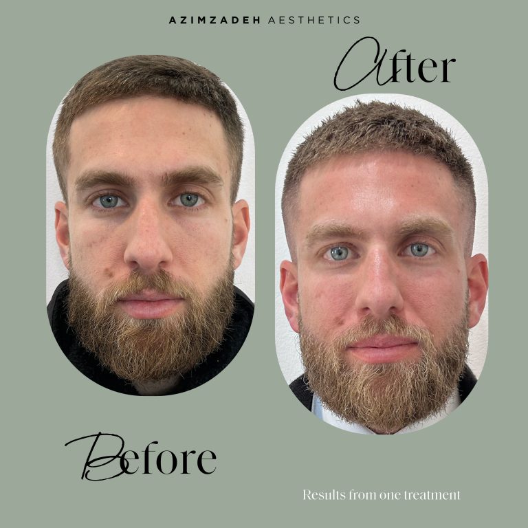skin dermal filler patient before after azimzadeh aesthetics