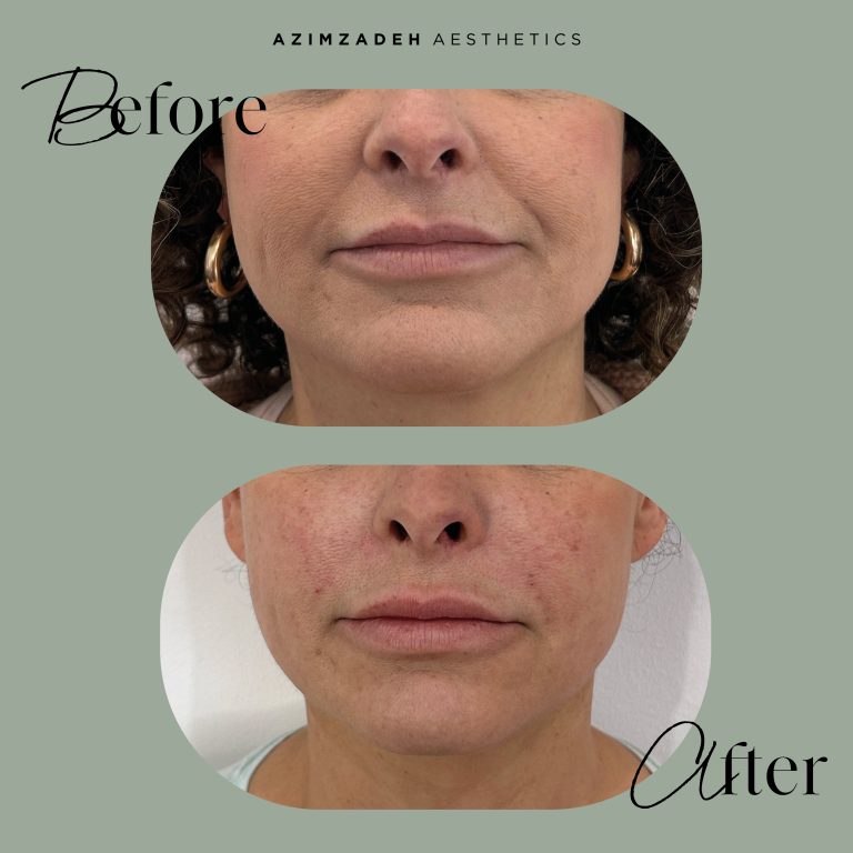 skin patient before after azimzadeh aesthetics