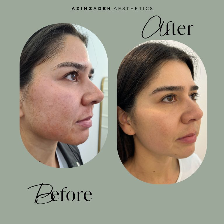skin patient before after azimzadeh aesthetics