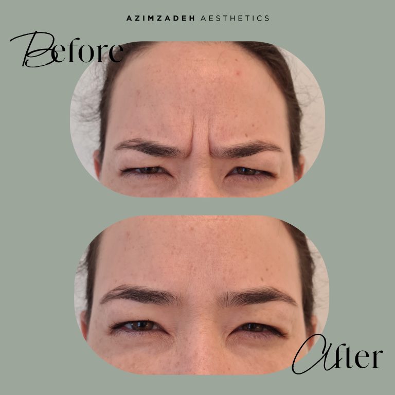 botox patient before after azimzadeh aesthetics