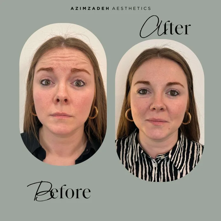 Azimzadeh Aesthetics Anti Wrinkle Before After