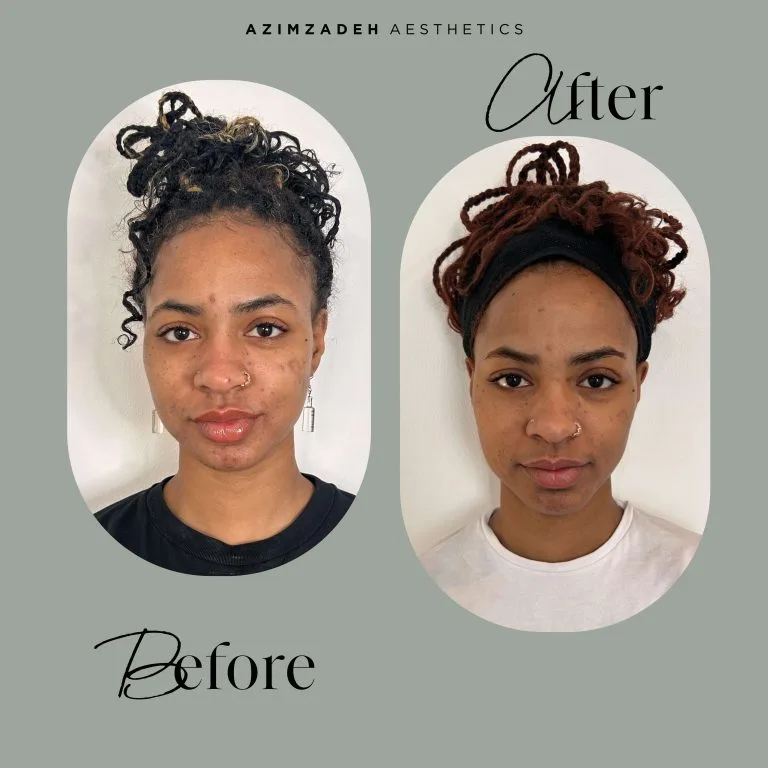 Azimzadeh Aesthetics Before After Perfect Peel